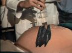 Incrustation sur le ventre d'un patient
